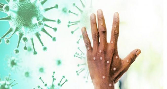 Bulaşıcı Hastalıklar Üst Komitesi'nden 'maymun çiçeği' kararları