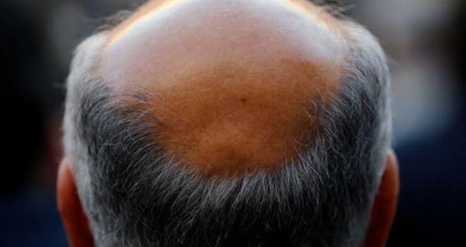 İngiltere'de erkeğe kel demek cinsel taciz sayıldı