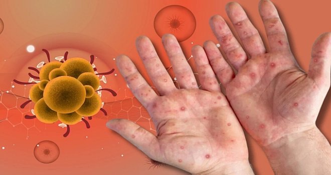 Maymun Çiçeği alarmı: Ülkeye Girişlerde Denetim Şart!