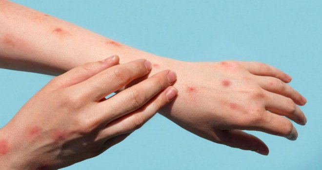Sağlık Bakanlığı: Bir hastada Maymun Çiçeği hastalığı tespit edildi
