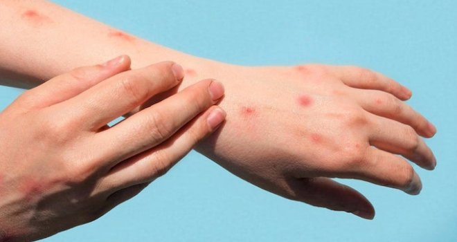 Sağlık Bakanlığı’ndan maymun çiçeği uyarıları: Belirtiler, yayılma yolları, kişisel önlemler